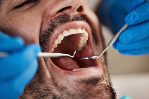 Best Chipped Tooth Repair Near Me  in Eaton Estates, OH